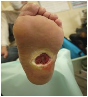 足潰瘍の写真
